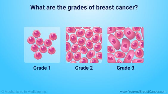 What is breast cancer grade?