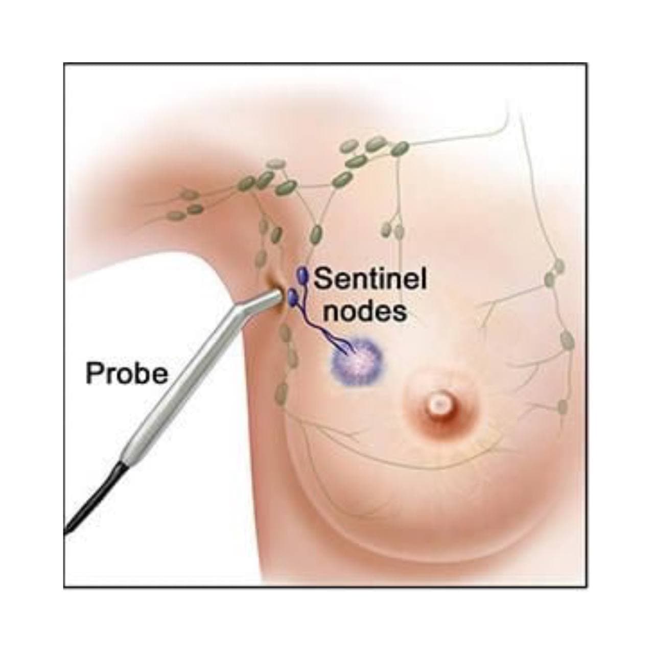 Protrusion of the mammary lymph nodes