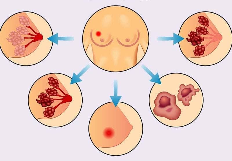 The different breast cancer types. Image extracted from